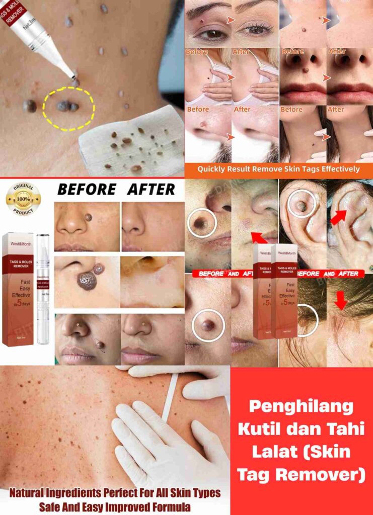 Penghilang Kutil dan Tahi Lalat (Skin Tag Remover) (1)